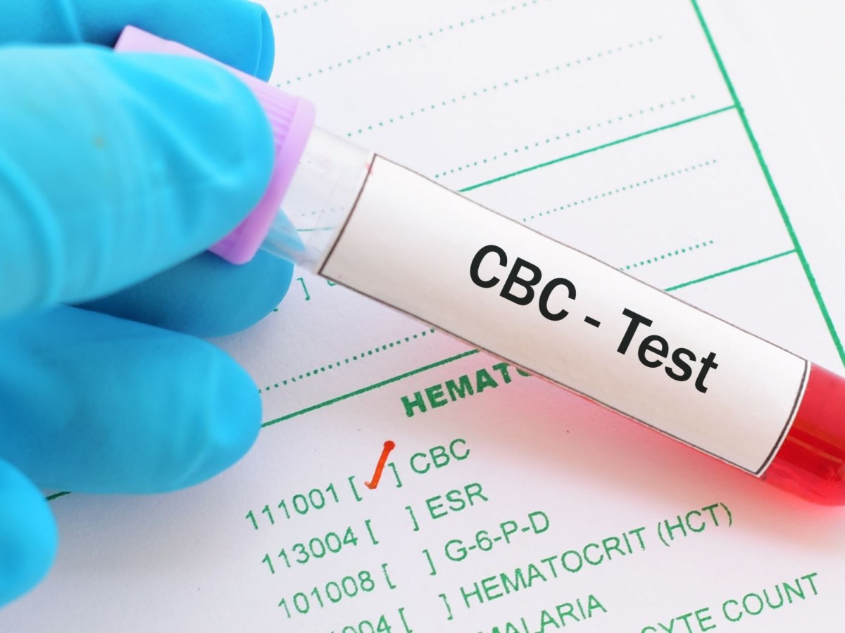 CBC Test Explained: What a Complete Blood Count Reveals About Your Health