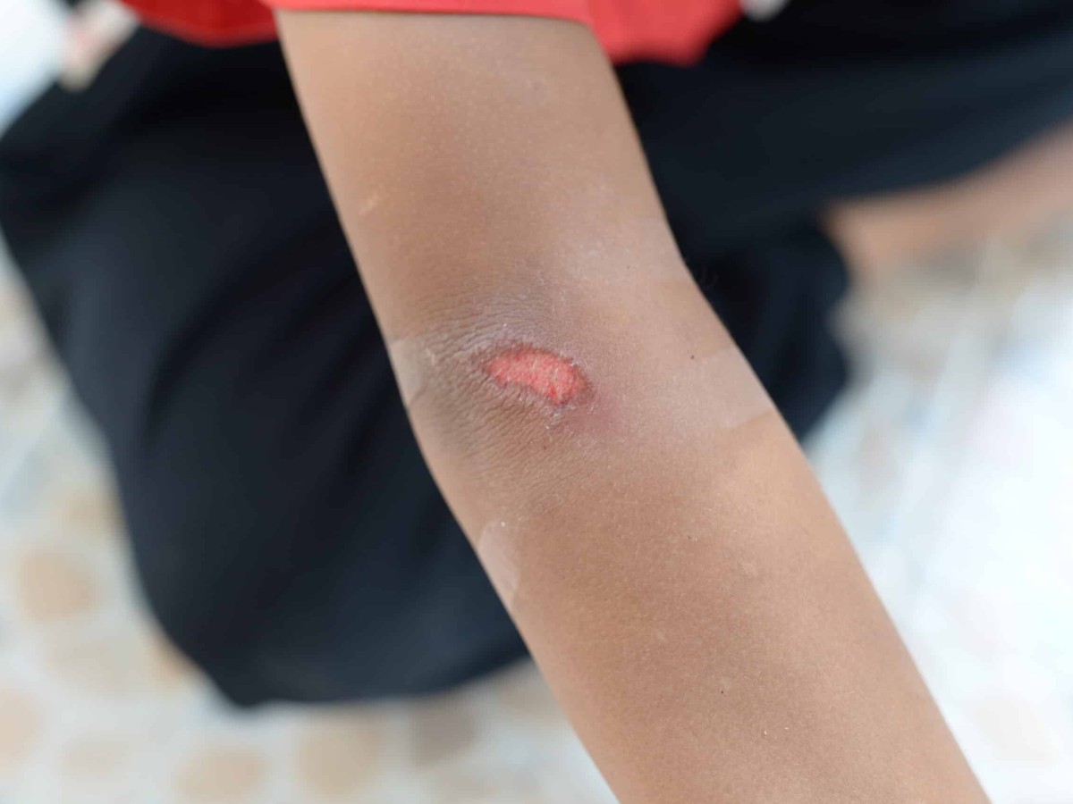 Wound Care in Dubai: A Simple Guide to Safe Healing at Home